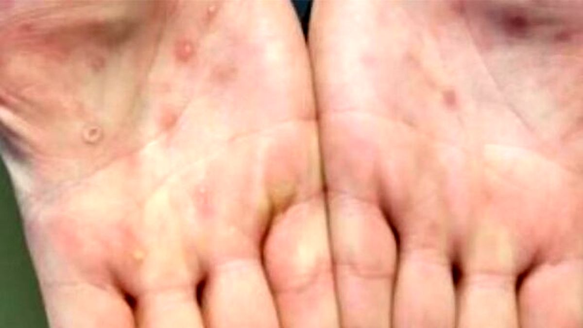 بهبودی بیمار مبتلا به آبله‌ میمونی در ایران / چه کسانی موارد مشکوک بیماری هستند؟