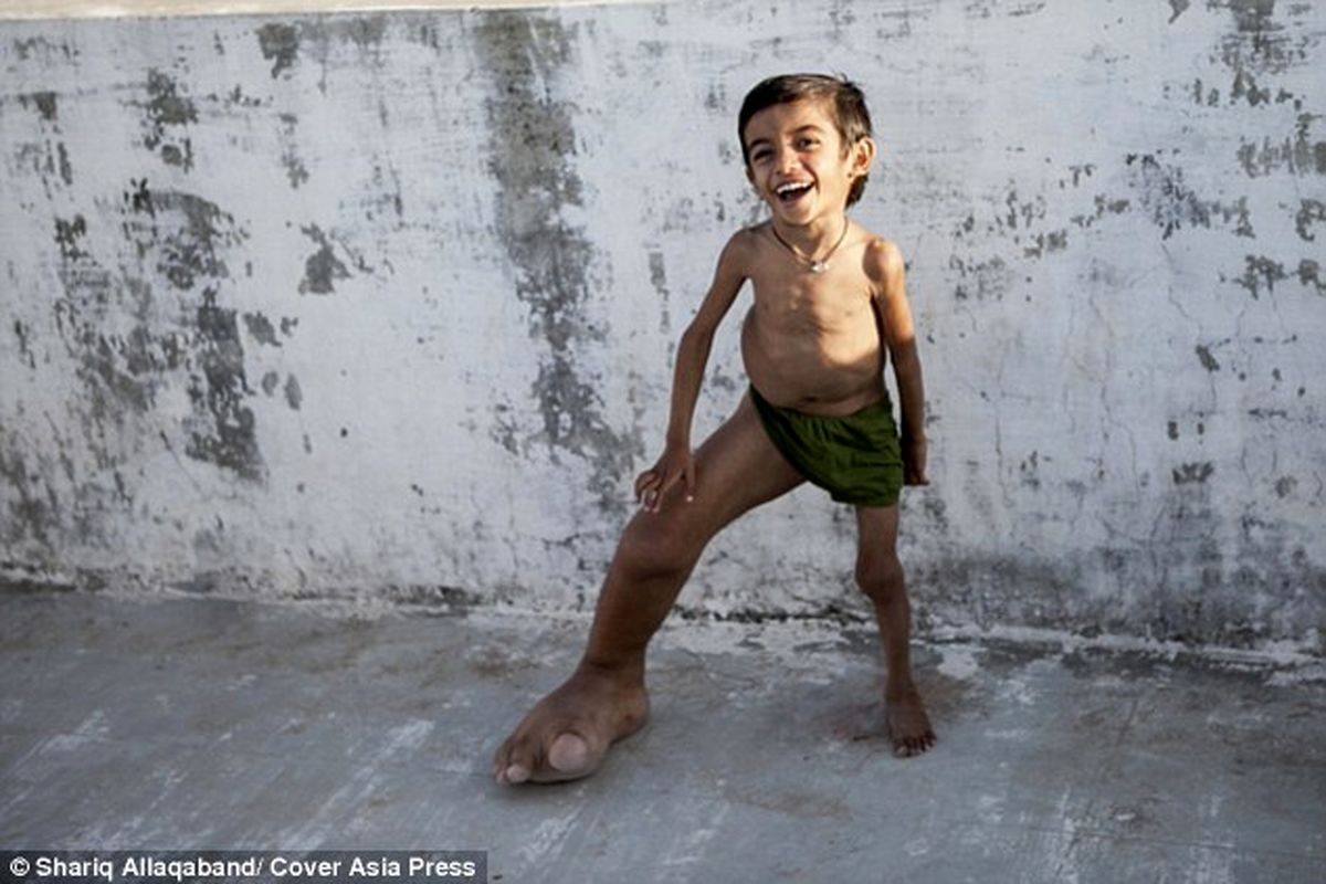 بیماری عجیب پسر ۴ساله هندی/تصاویر