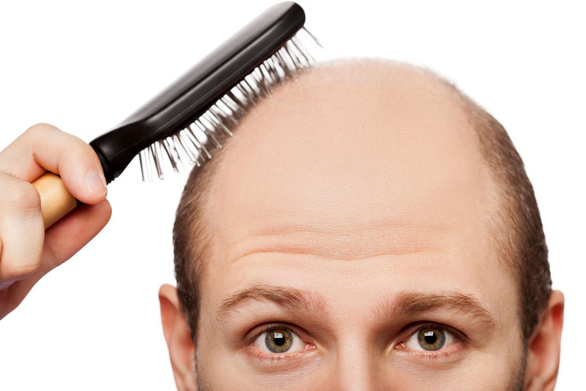 کدام ریزش مو غیرقابل برگشت و کدام قابل برگشت است؟