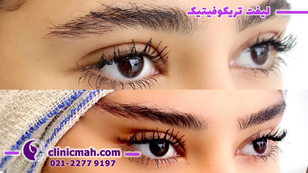  معجزه جوان سازی با لیفتینگ و مزایا و عوارض آن