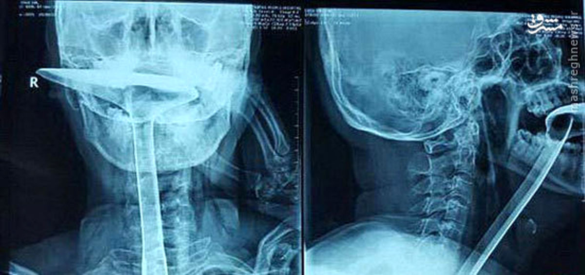 زنی که کفگیر آشپزخانه را بلعید +عکس