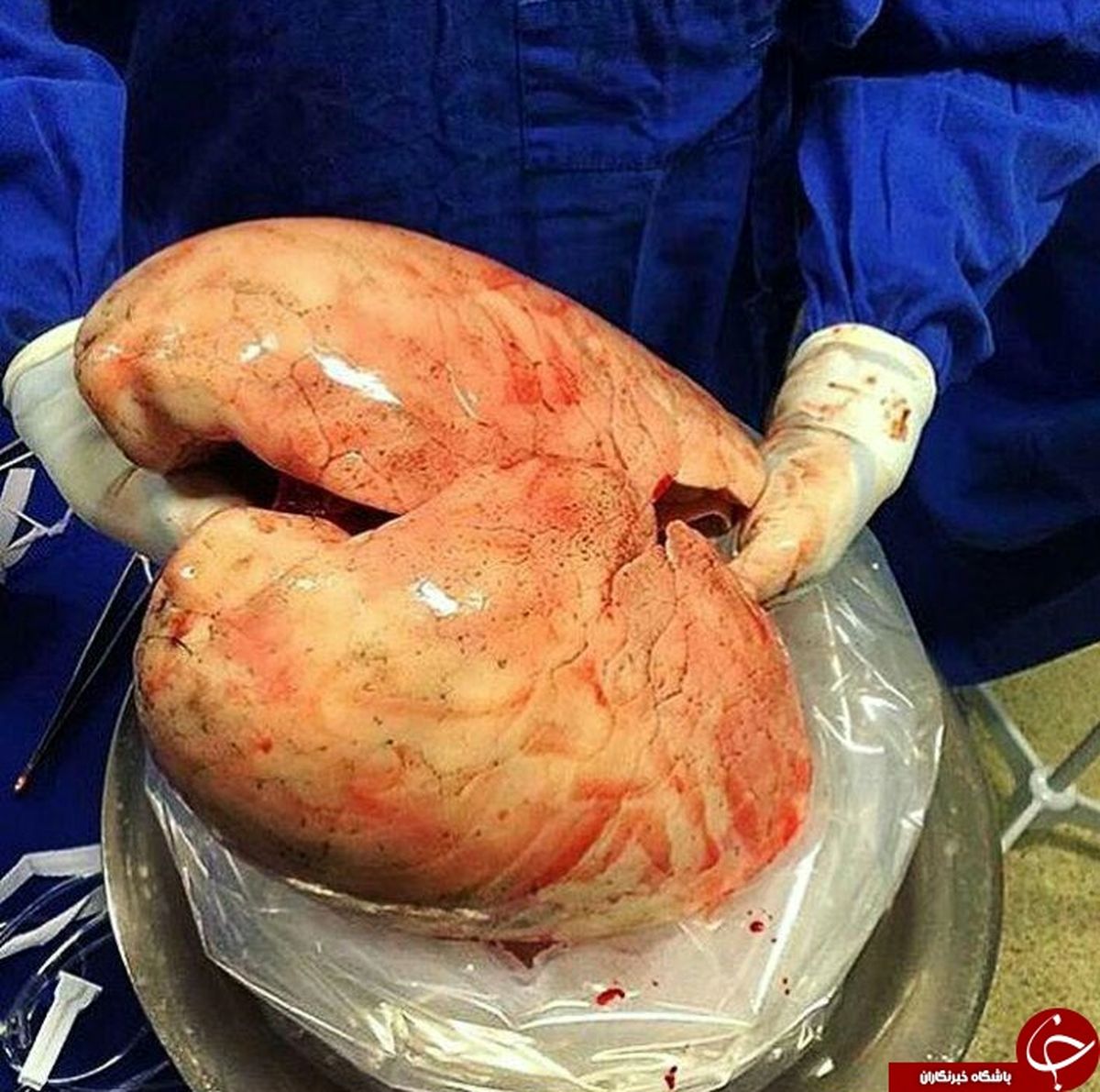 نمایی نزدیک از پیوند ریه +عکس