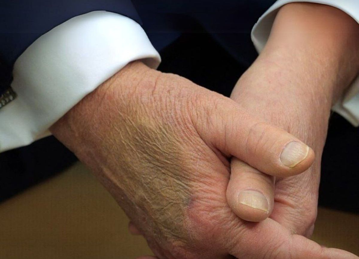 دلیل کبودی دست ترامپ فاش شد!