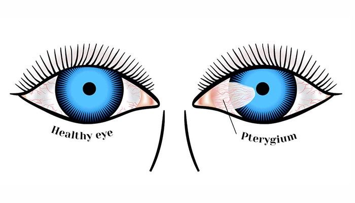 عمل ناخنک چشم چگونه است و چقدر طول می‌کشد؟