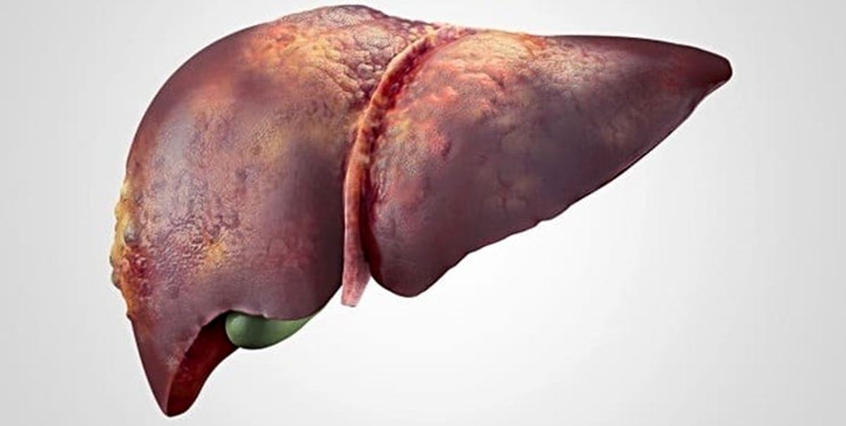  مهمترین روش درمان کبد چرب و چاقی