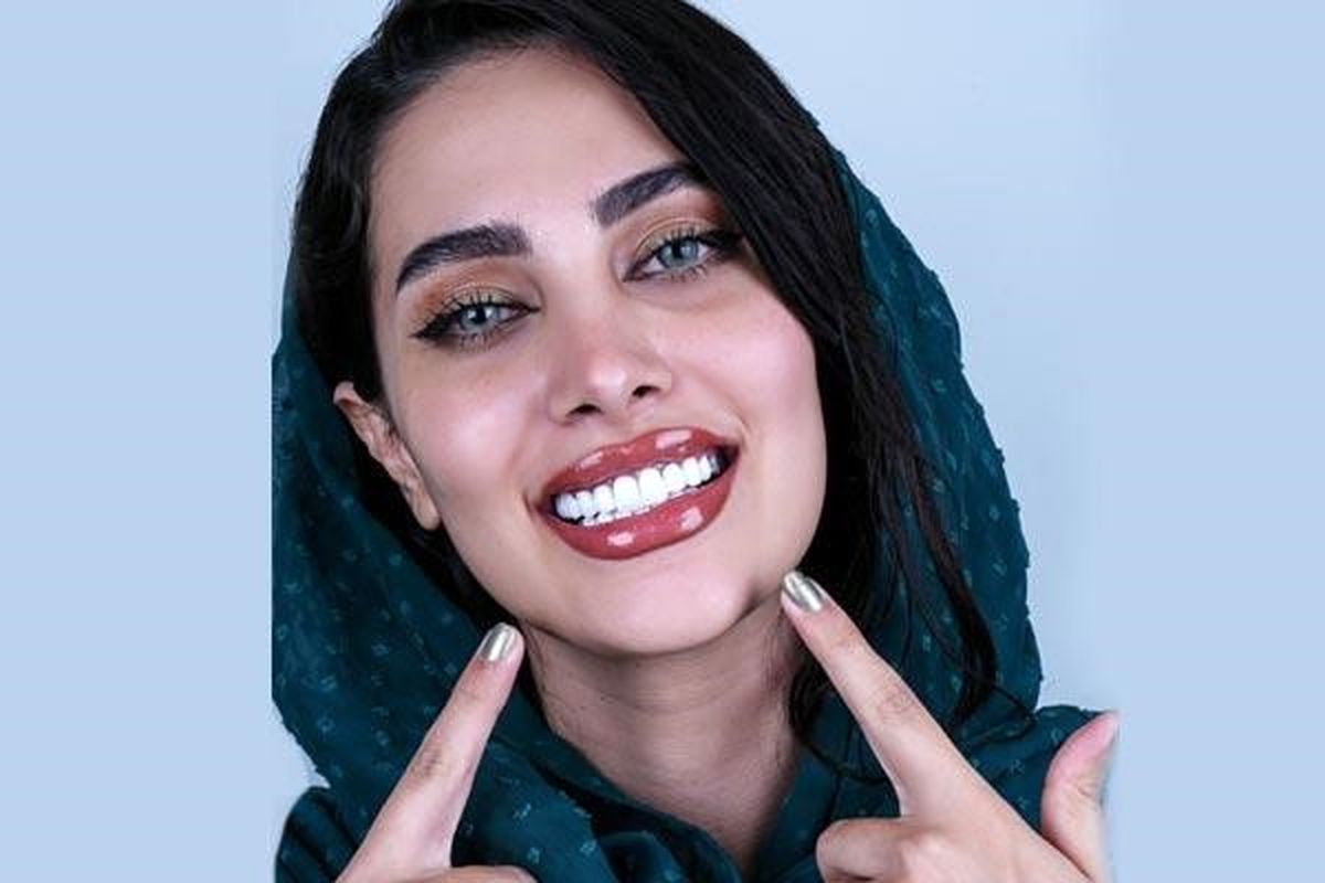 اگر قصد انجام لمینت دندان دارید حتماً این مطلب را بخوانید