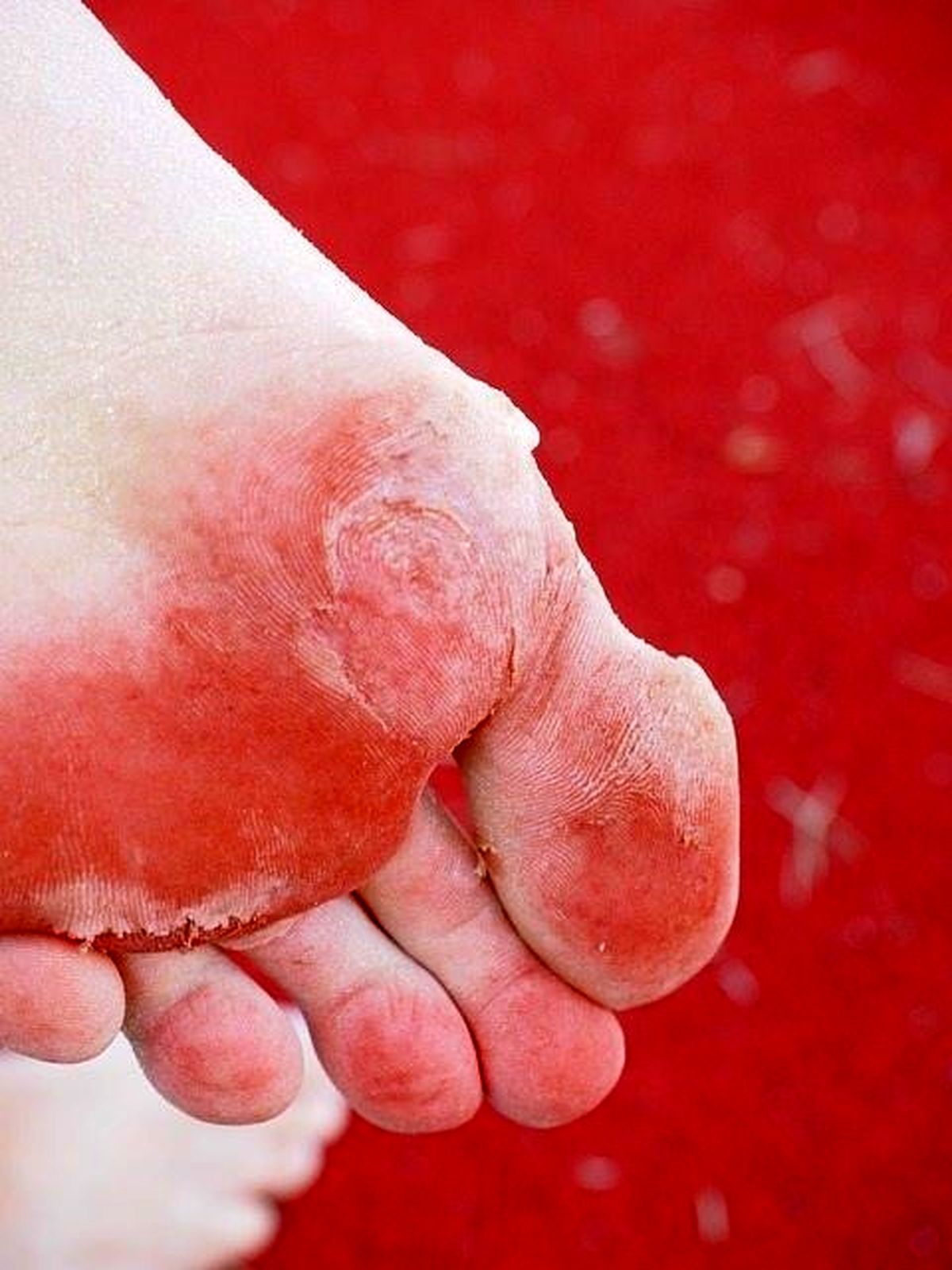 علائم قرمز برای زخم پای دیابتی چیست؟
