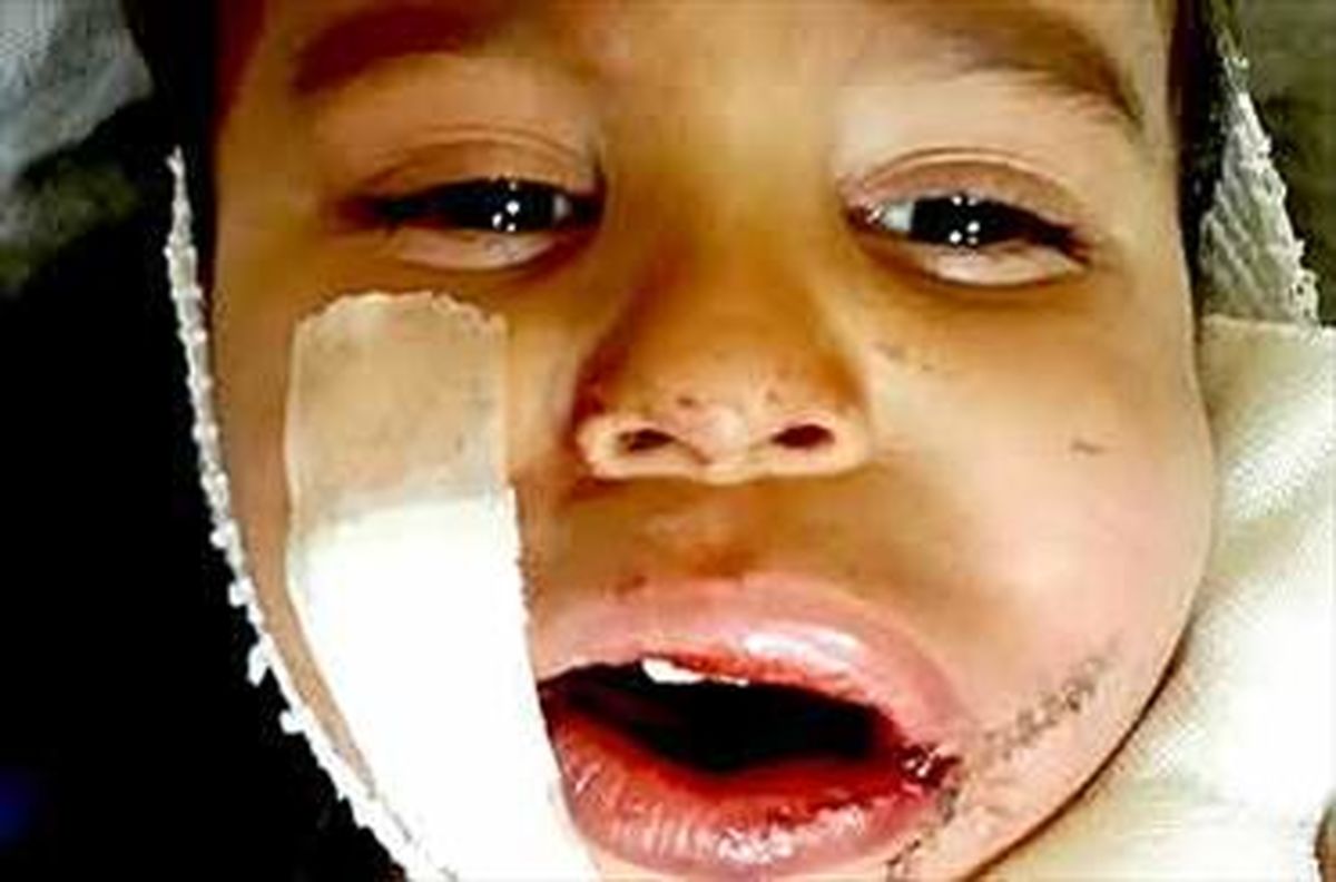 انفجار ترقه در دهان کودک 3 ساله/عکس