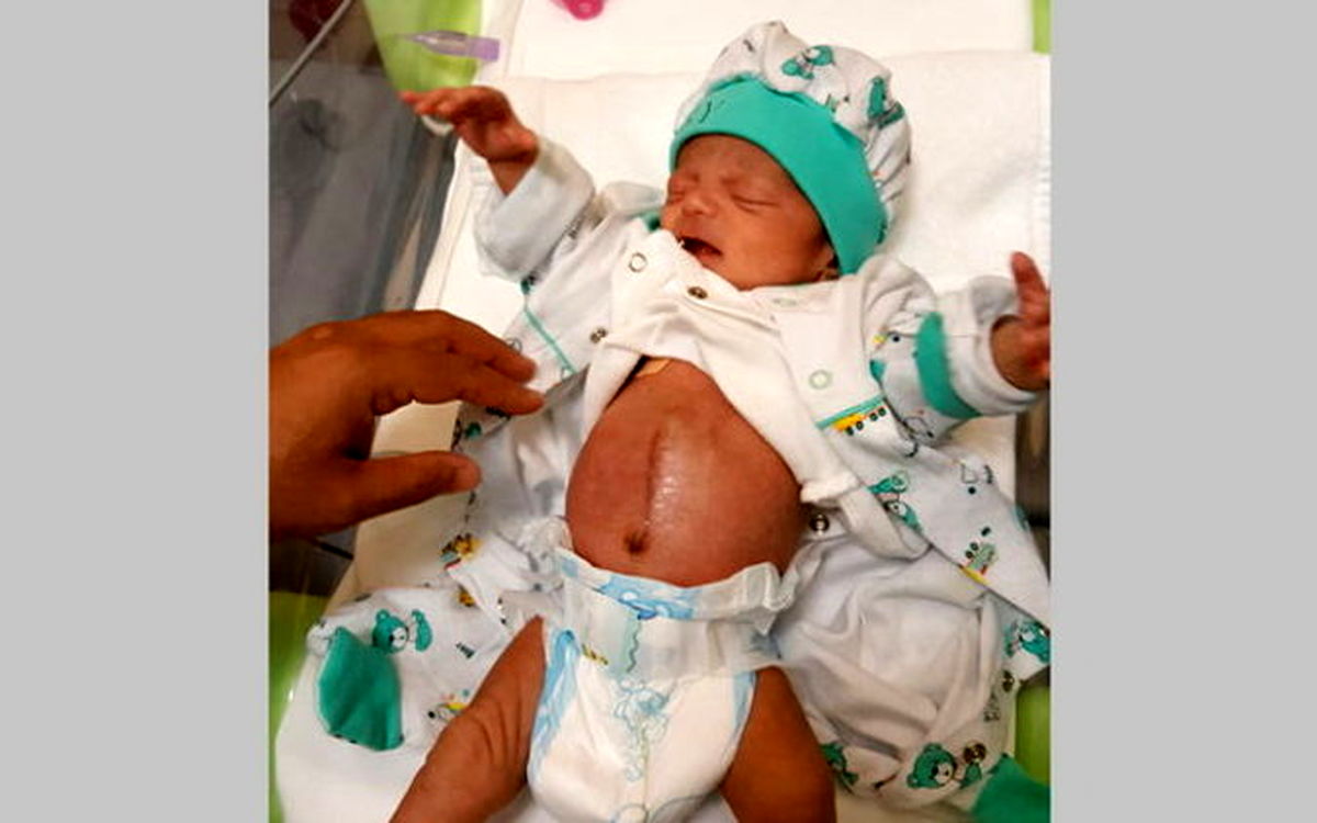 نوزادی که معده و کبد او خارج از شکمش بود! +تصاویر