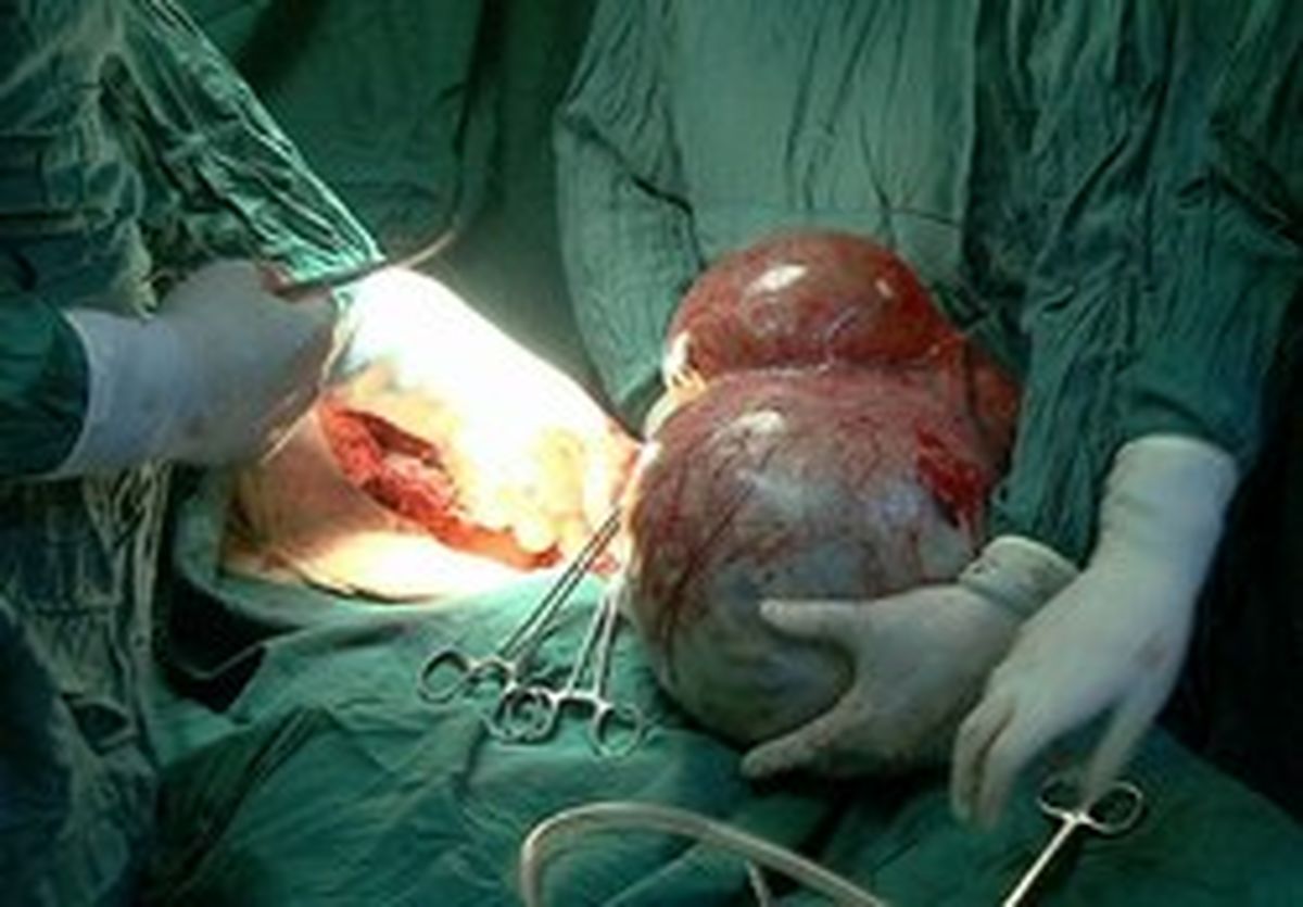 توده ۱۲ کیلوگرمی در شکم پیرزن ۸۷ ساله مراغهای +عکس