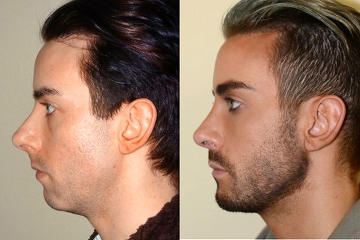 ایمپلنت چانه؛ عمل زیبایی پرطرفداری که ضرورتی هم ندارد