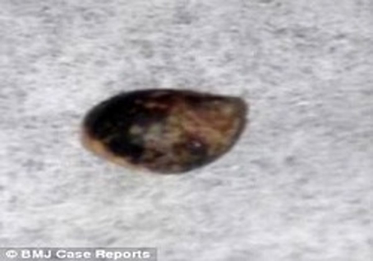 خروج حلزون زنده دریایی از دست یک کودک! +عکس