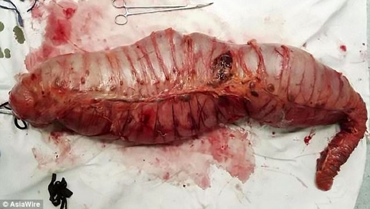 خارج کردن ۱۲ کیلو مدفوع از شکم یک مرد! +تصاویر