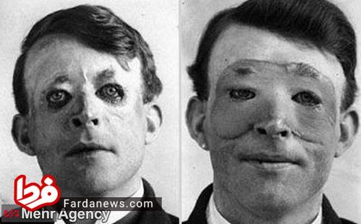 نخستین کسی که جراحی پلاستیک کرد +عکس
