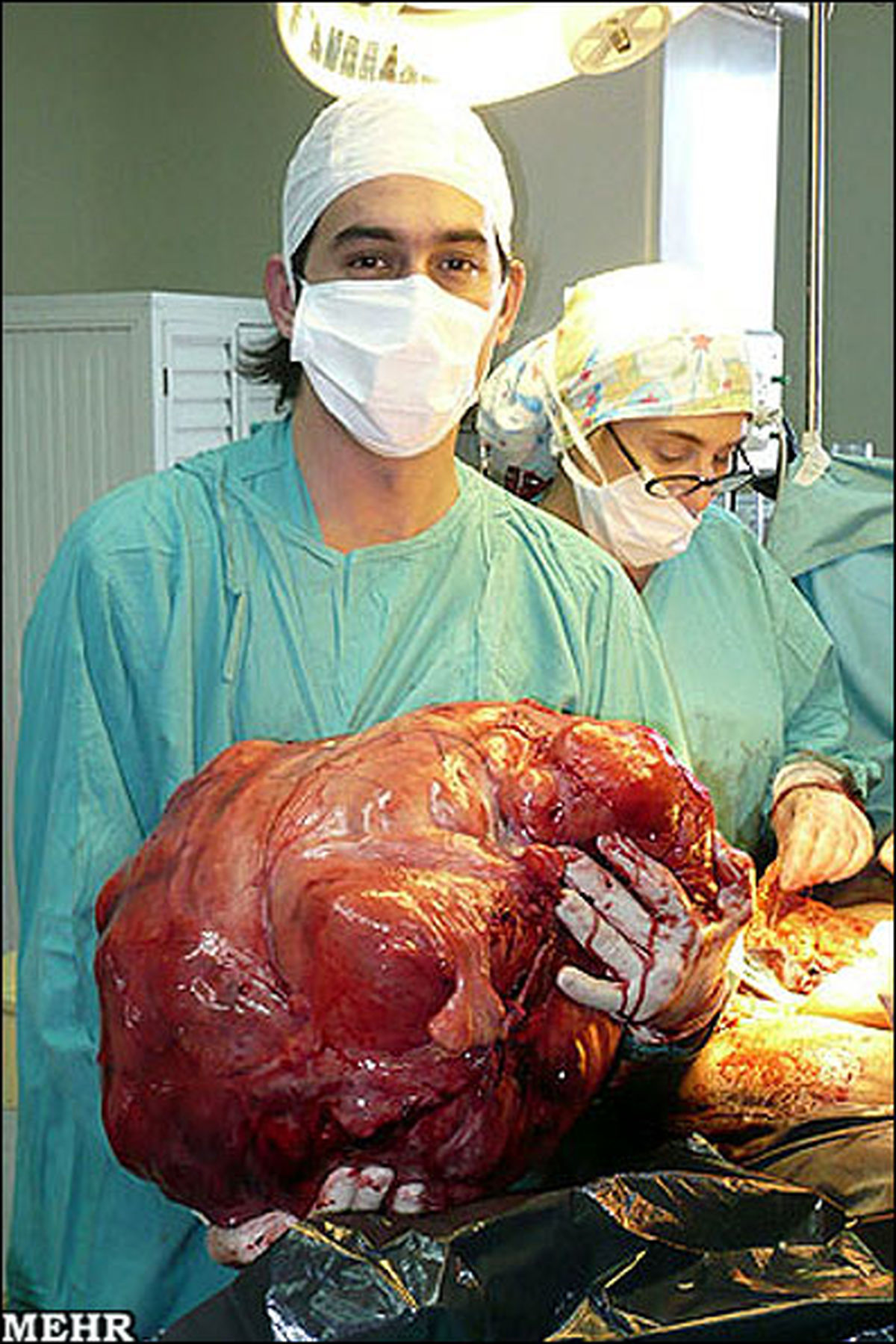 تصویر: بزرگترین تومور