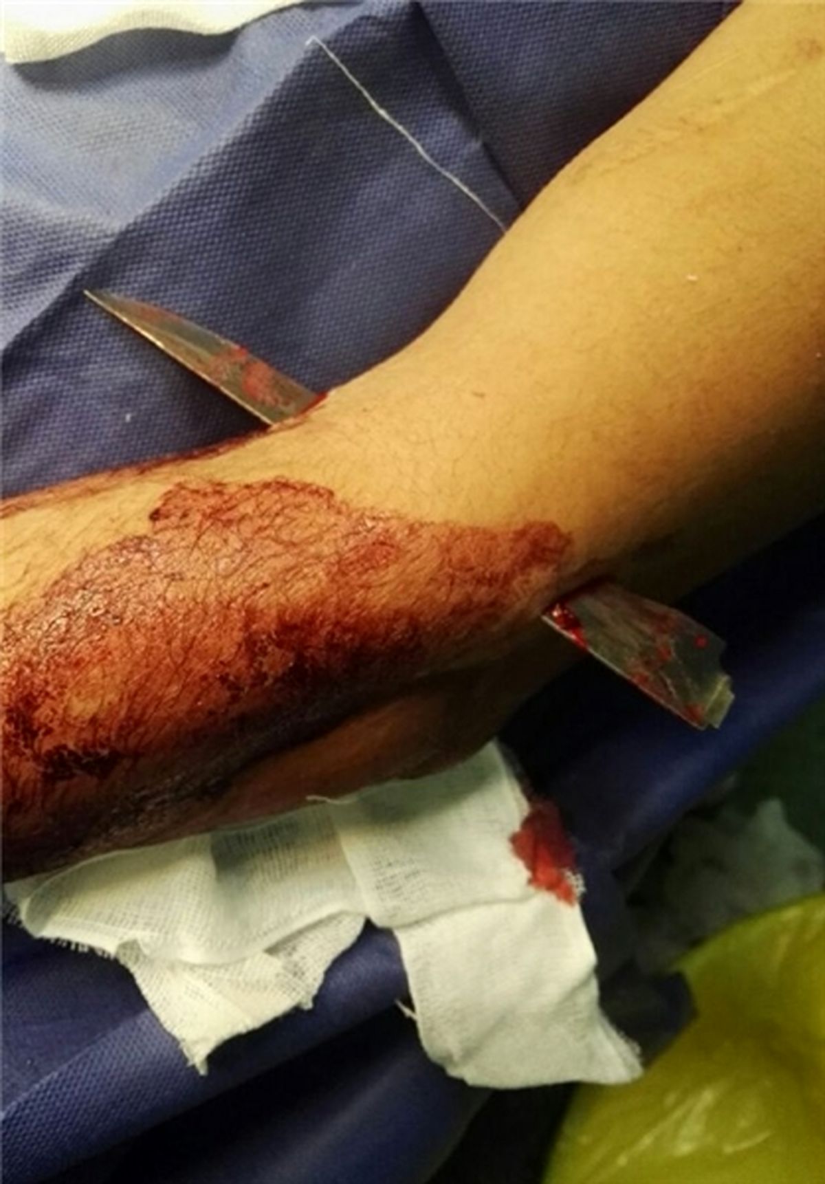 خروج چاقوی 10 سانتی از دست جوان 33 ساله +عکس