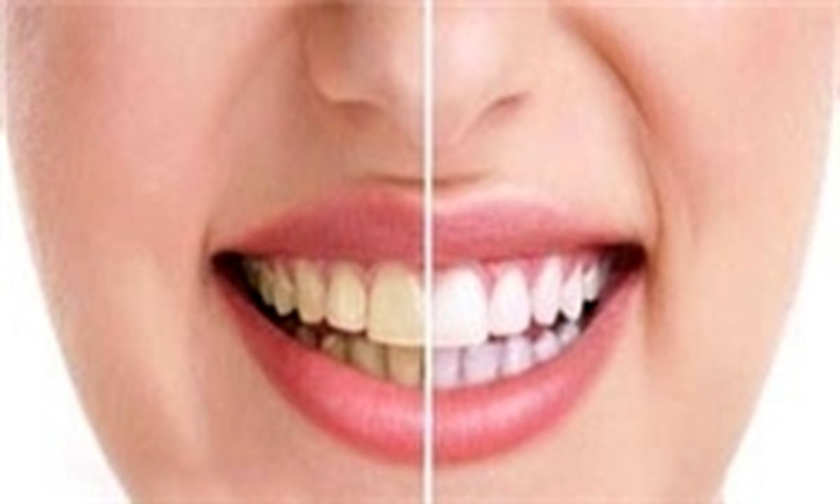 ماجرای نایاب شدن کارپول بیحسی دندان