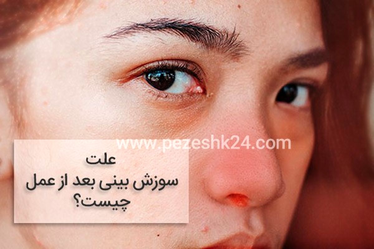 علت سوزش بینی بعد از عمل چیست؟ عوارض و روش درمان 