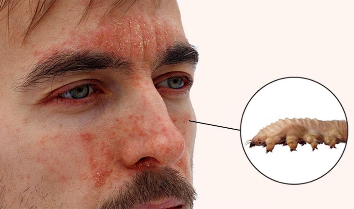 درباره نقش دمودکس در عارضه های پوست و مو چه می‌دانید؟