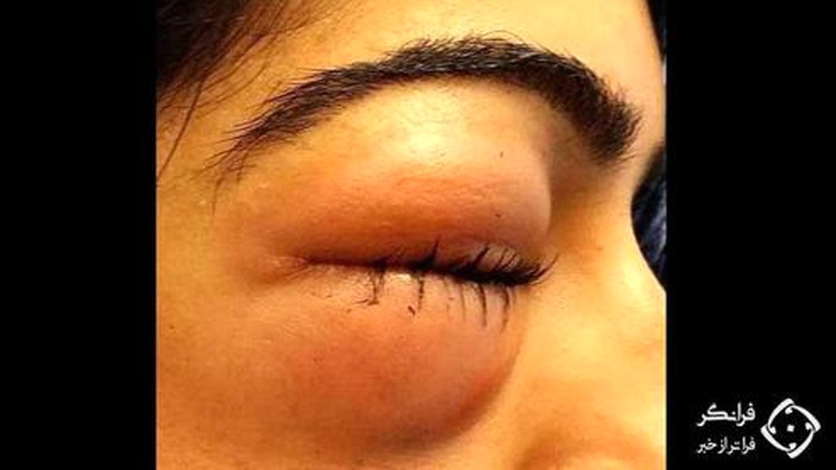 نابینا شدن زن جوان به دلیل فشار زیاد به بینی +عکس