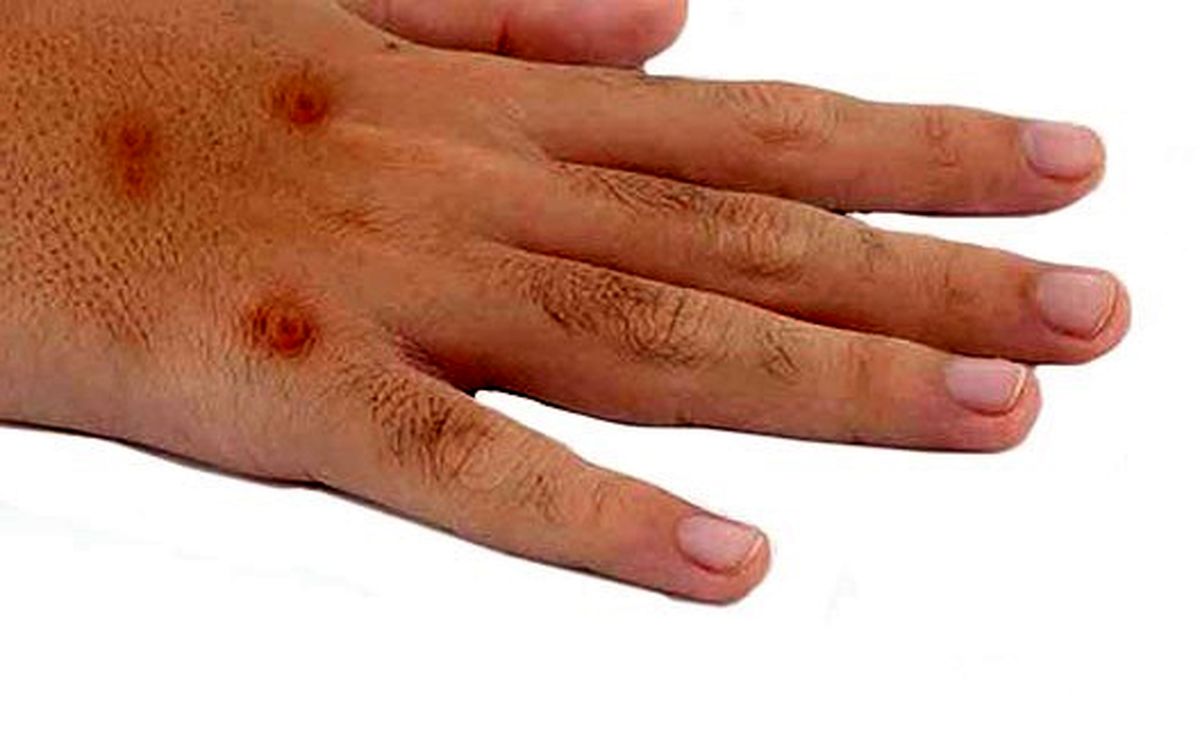 ۱۰ درمان خانگی زگیل