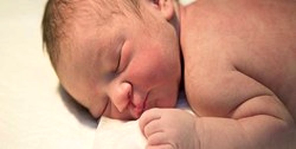 «سندرم پیررابین» را بشناسید