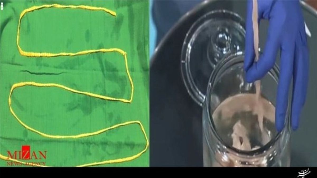 خارج کردن کرم دو متری از شکم مرد هندی +عکس