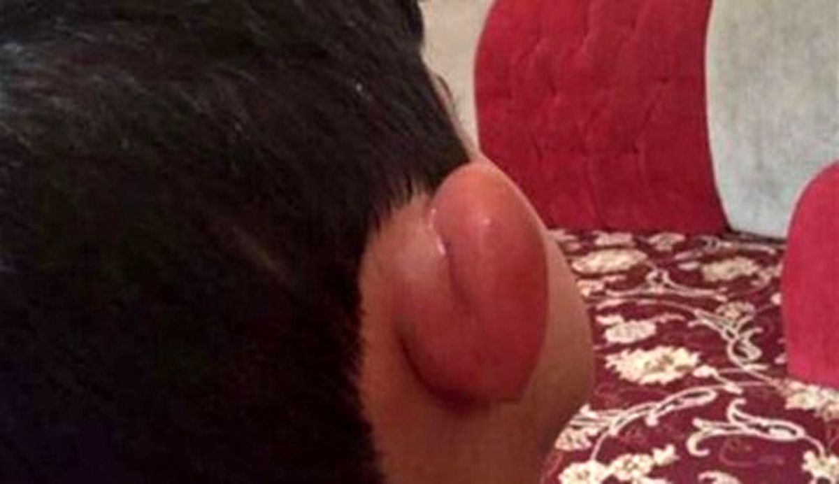 مسابقۀ زیباترین نیش پشه +عکس