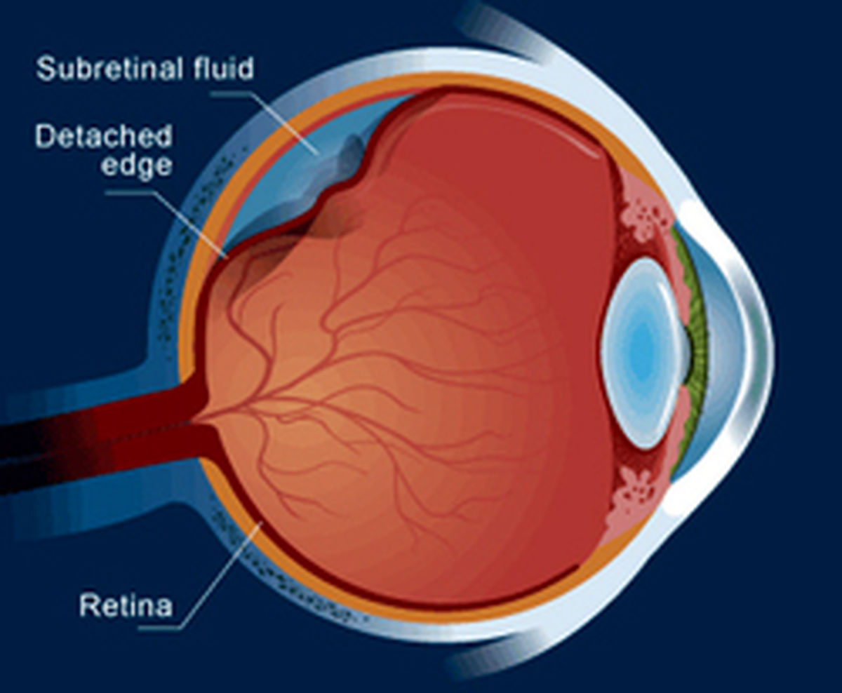 جدا شدگی پرده شبکیه از تشخیص تا درمان