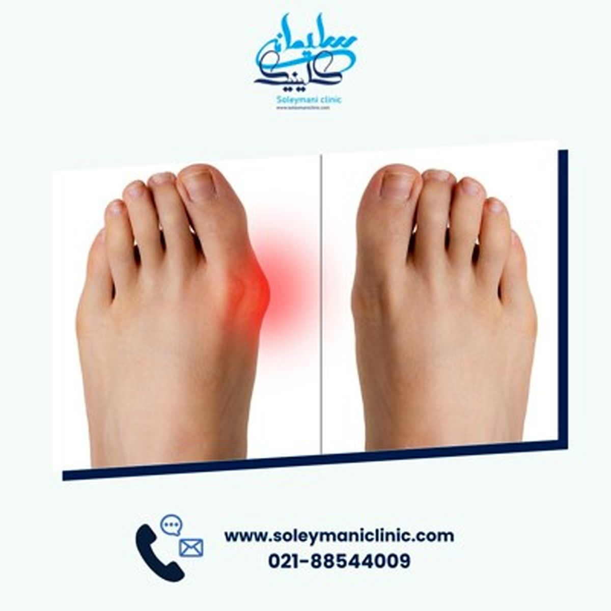 هالوکس والگوس یا عارضه انحراف شست پا چیست