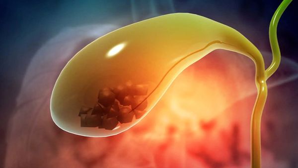  «ماهی خام» سنگ کیسه صفرا را دفع می‌کند؟