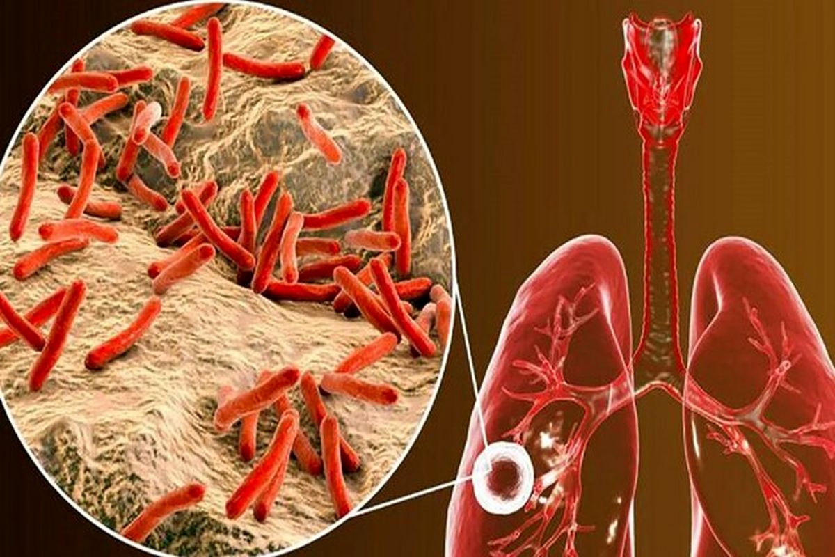 آشنایی با بیماری سل و پیشگیری از ابتلا به آن