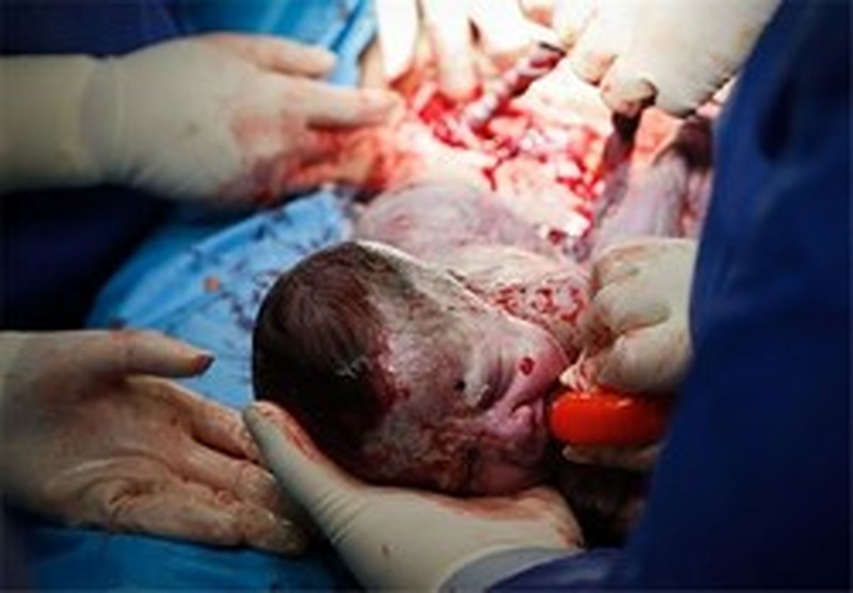 چگونه آمار سزارین در ایران کاهش یافت؟