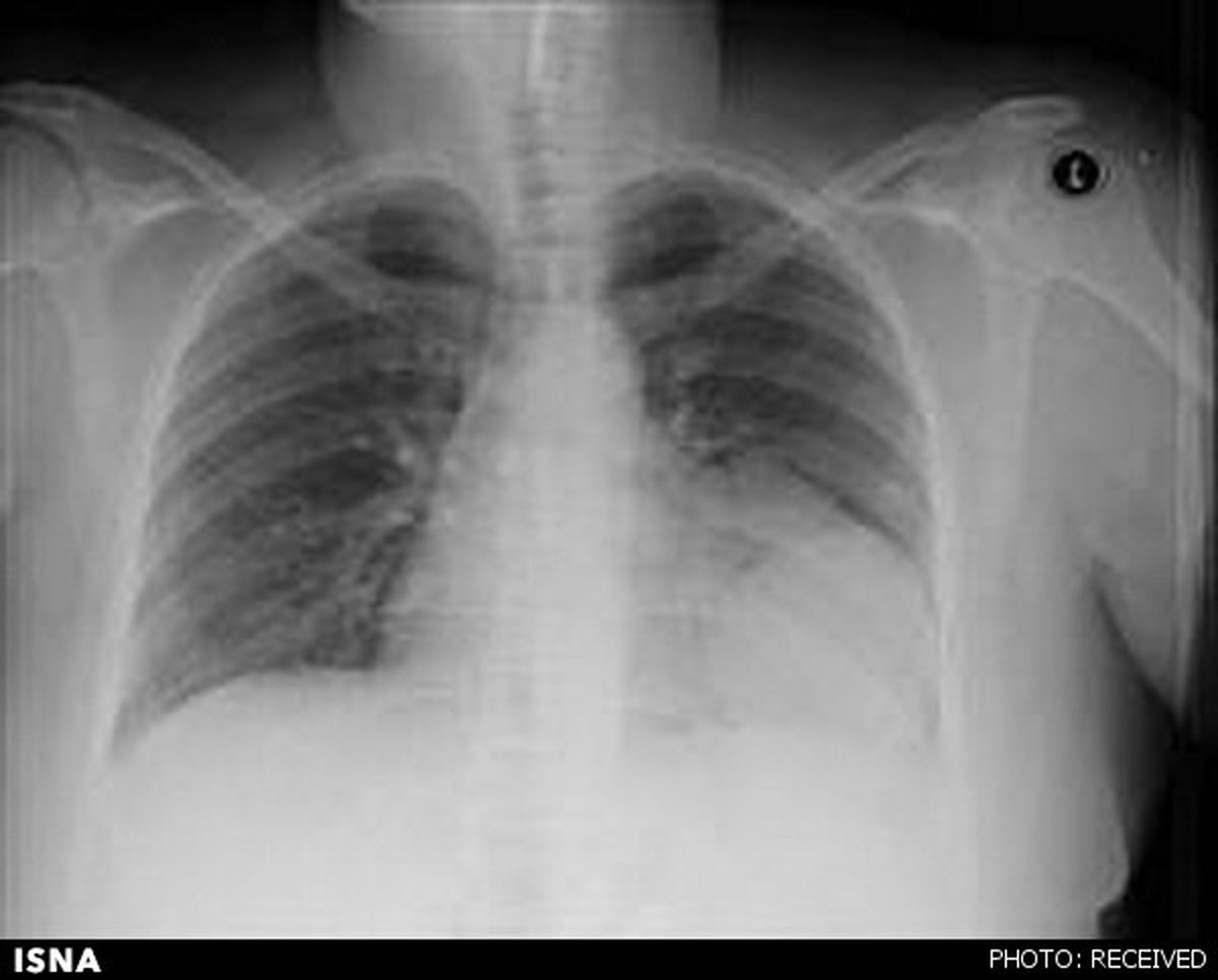 قلبی که 90 درجه چرخید!/عکس