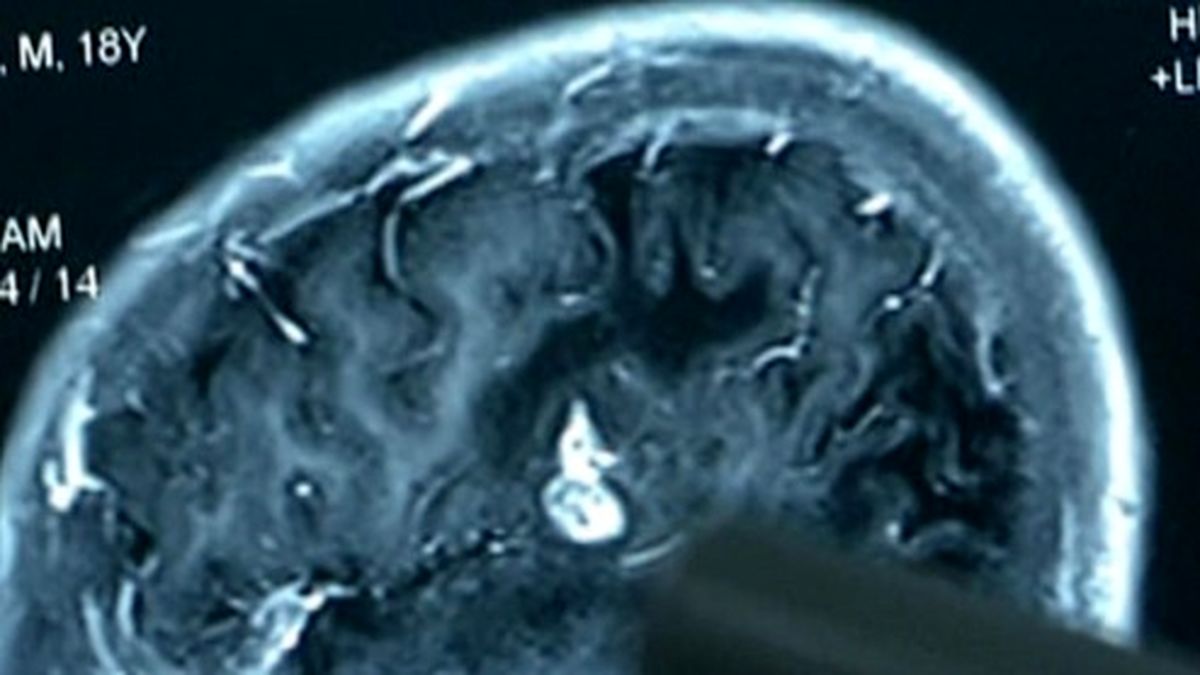 پیداشدن انگل ۱۲ سانتی در مغز مرد جوان! +فیلم