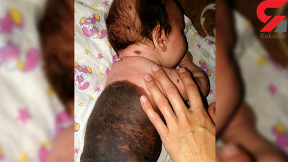 سلاخی یک نوزاد دختر به خاطر خال بزرگ در بدنش! +عکس
