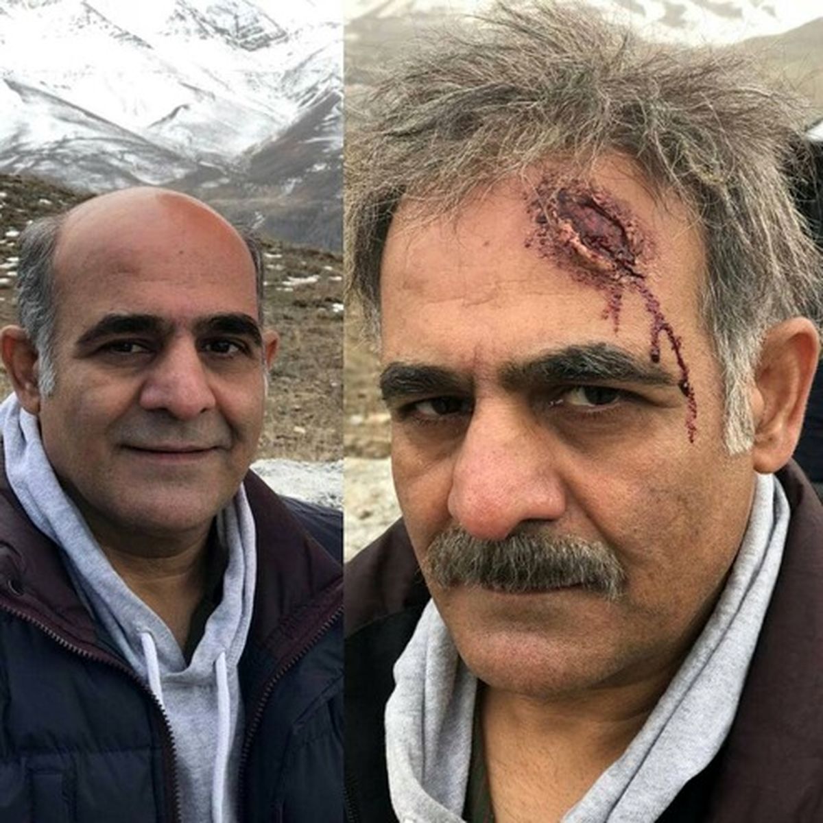 پیشانی خونین بازیگر پیشکسوت +عکس