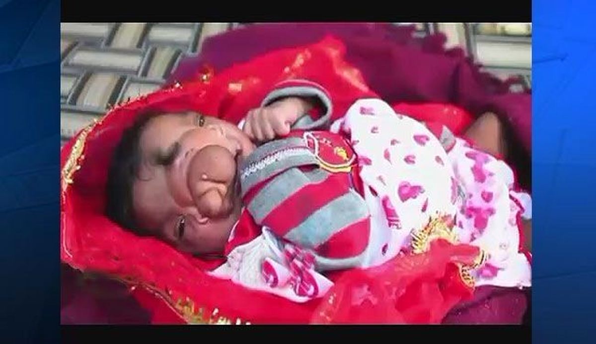 نوزادی با خرطوم فیل به دنیا آمد!/عکس