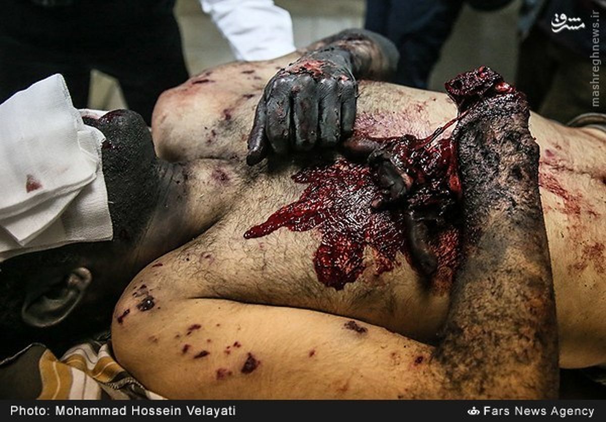 وحشتناک‎ترین‎مصدوم‎چهارشنبه‎سوری/عکس