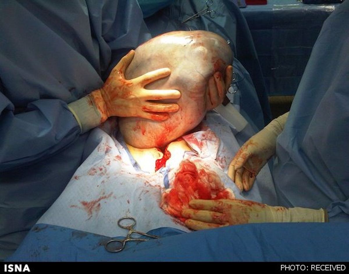 تومور12کیلویی درشکم بیماربرزیلی/عکس