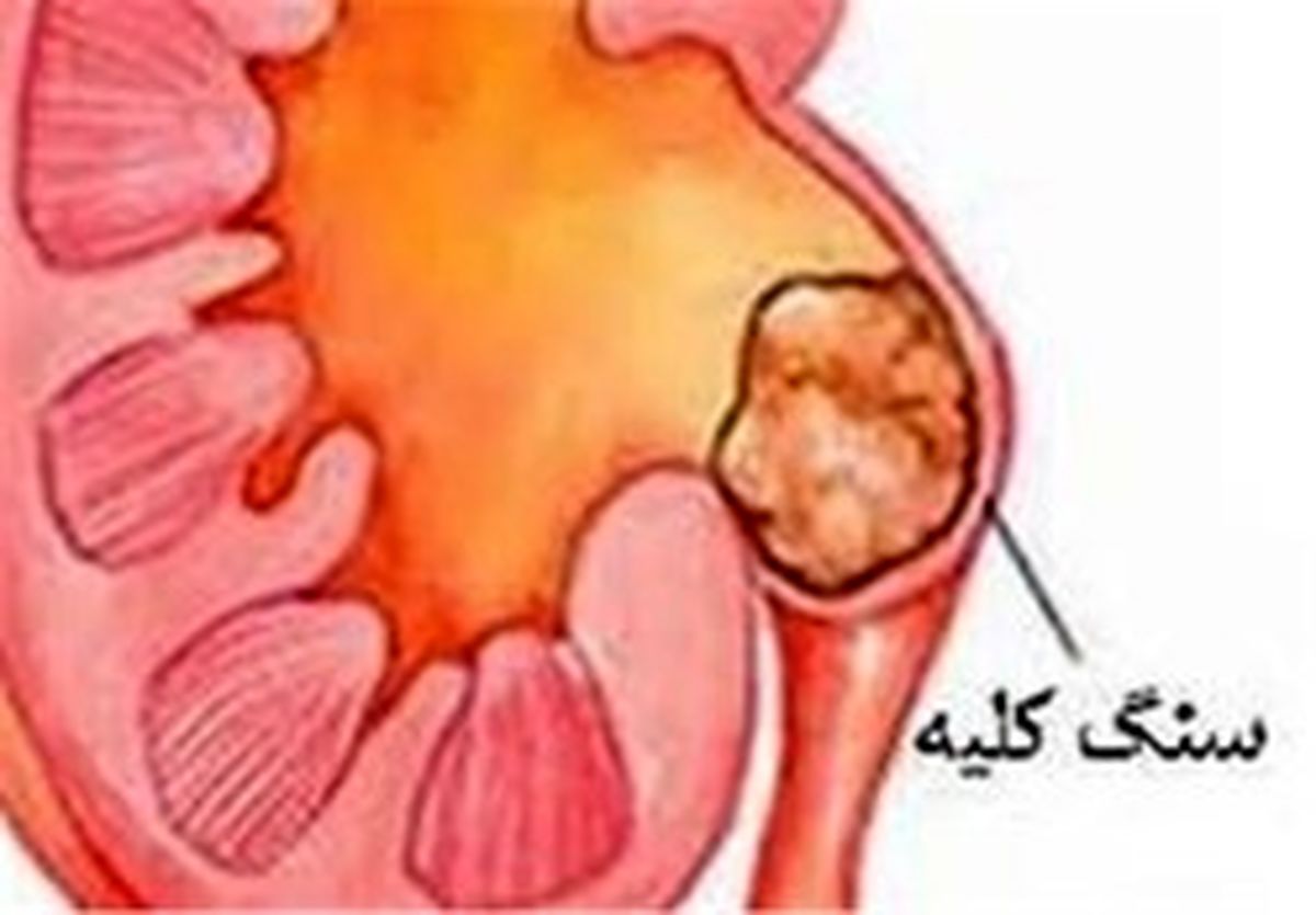 چه کنیم تا «سنگ کلیه» نگیریم؟
