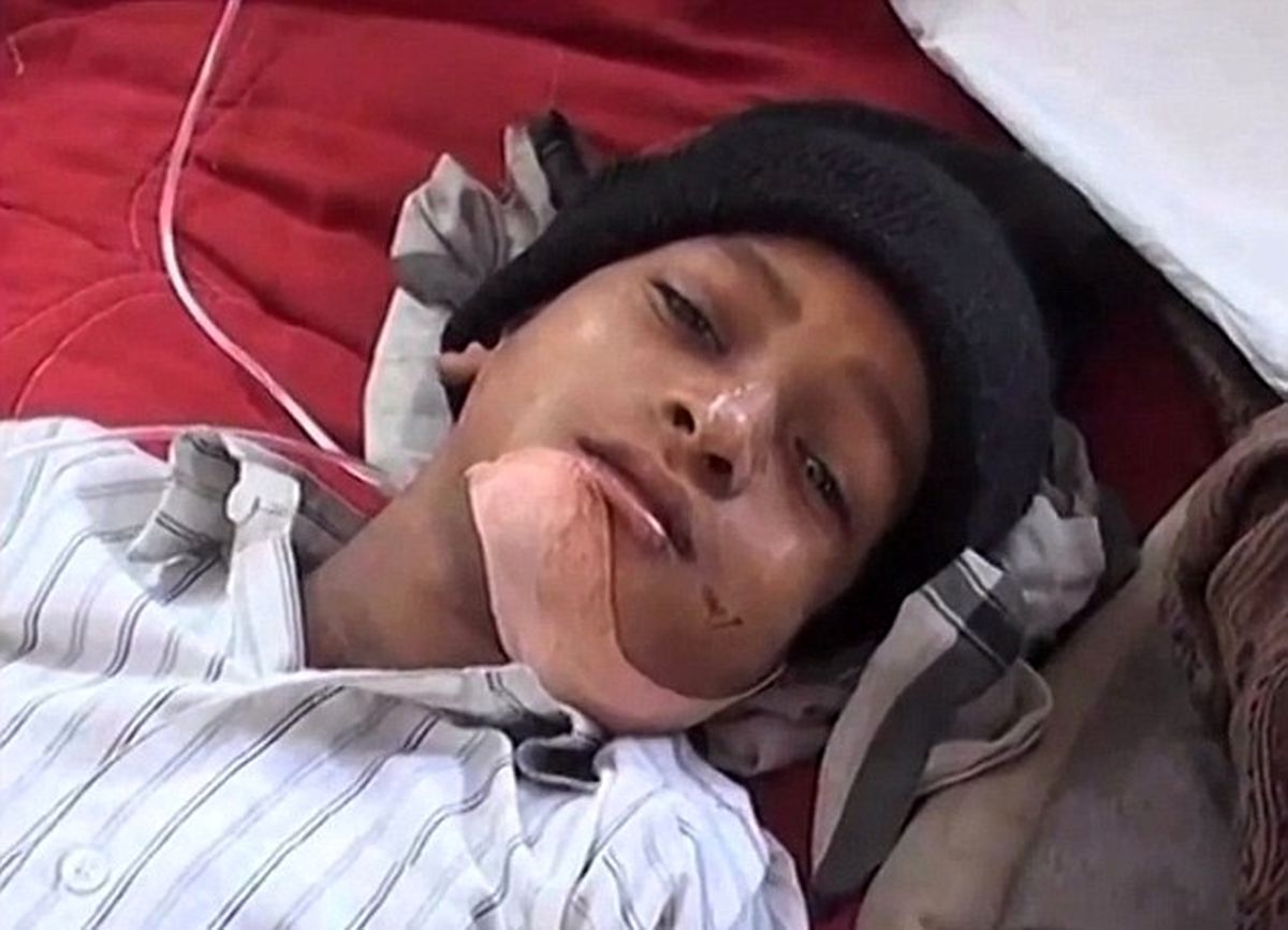 کودکی با ۸۰ دندان اضافی/ تصاویر