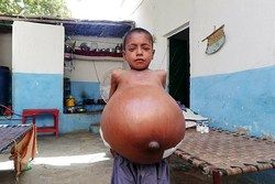 بیماری نادر پسر ۹ ساله +عکس