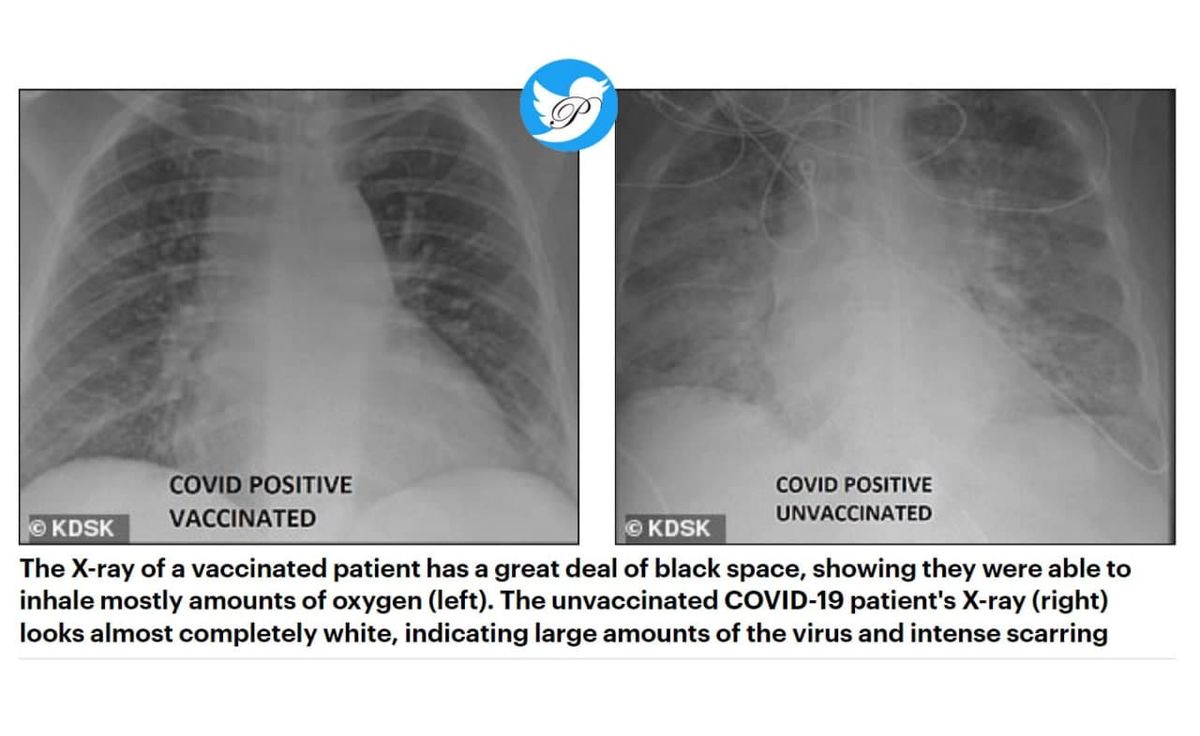 تصویر ریه دو فرد کرونامثبت که یکی {سمت چپ تصویر} واکسن زده