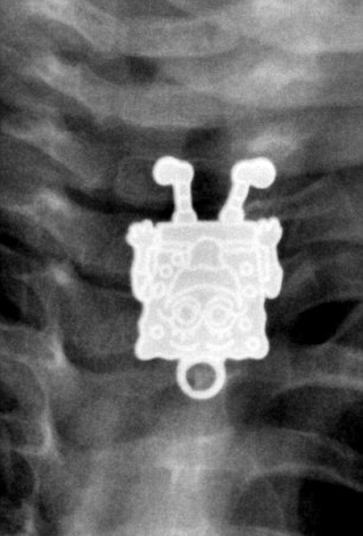 شی عجیب‌ درگلوی نوزادعربستانی/تصاویر