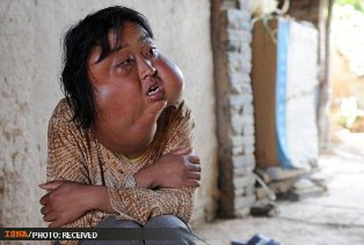 بیماری عجیب زن چینی/ عکس