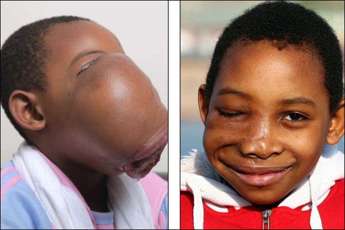 غده 2کیلویی درصورت دختر 8ساله/عکس