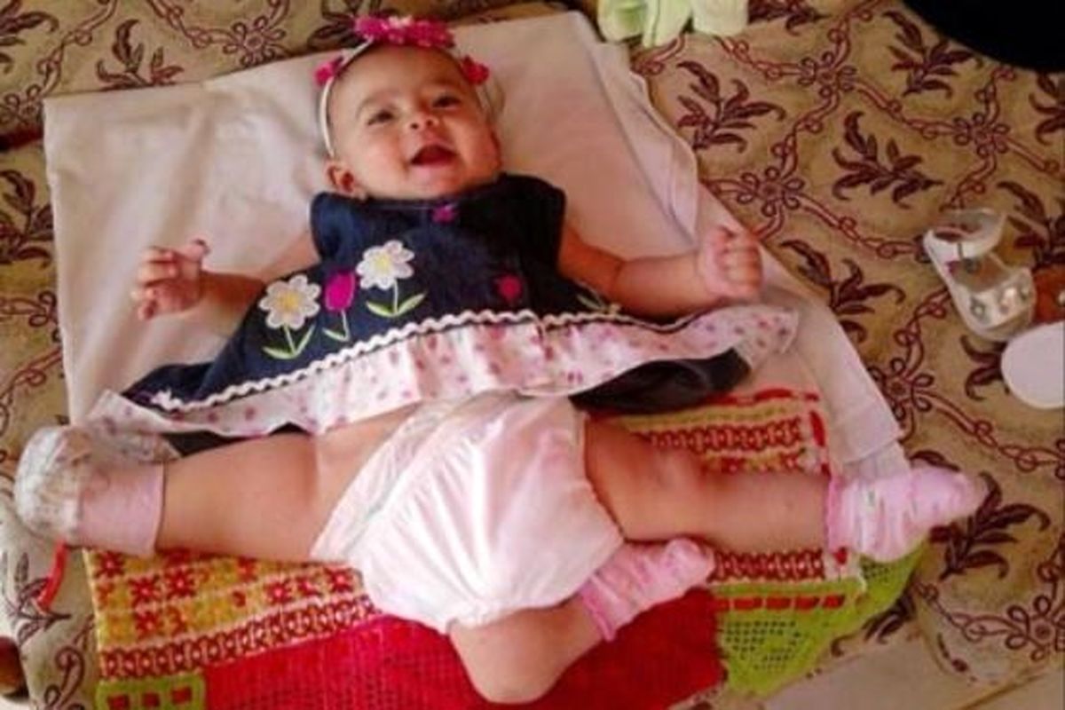 دختری زیبا با 3 پا/عکس