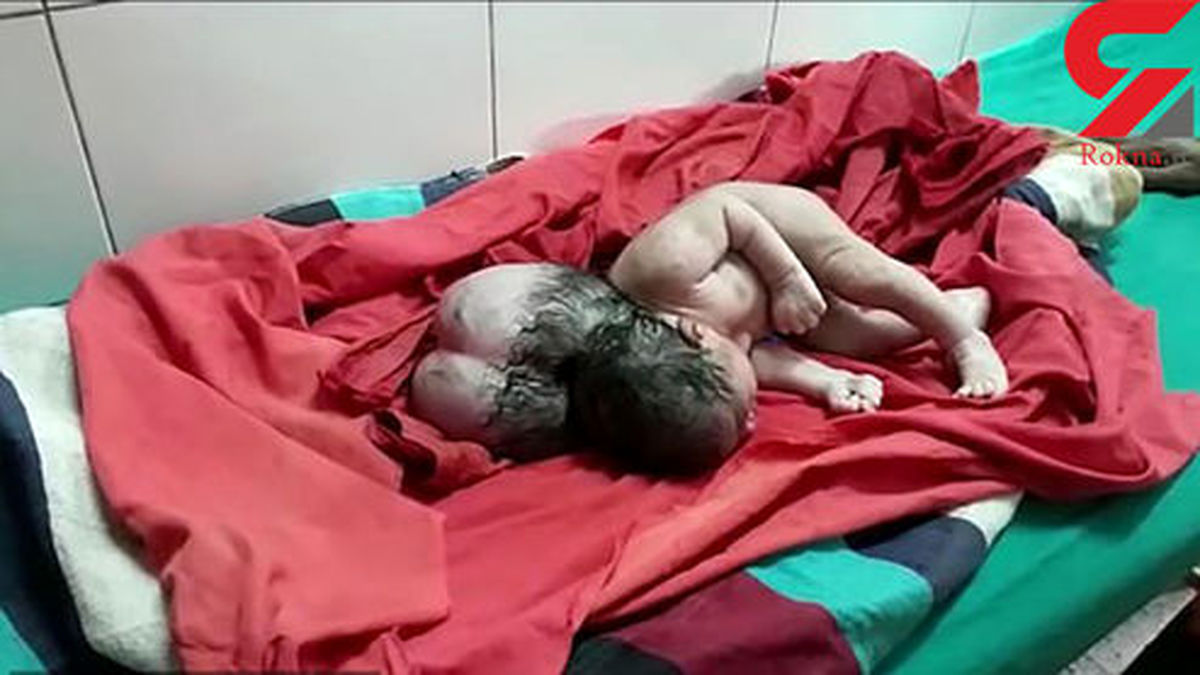 نوزادی که با ۳ سر در هند به دنیا آمد +عکس عجیب