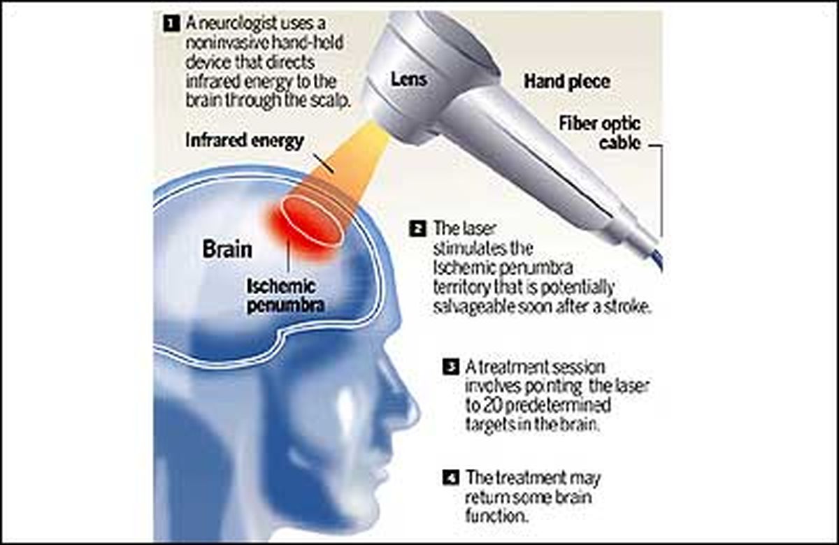 سکته های مغزی با لیزر درمان می شوند